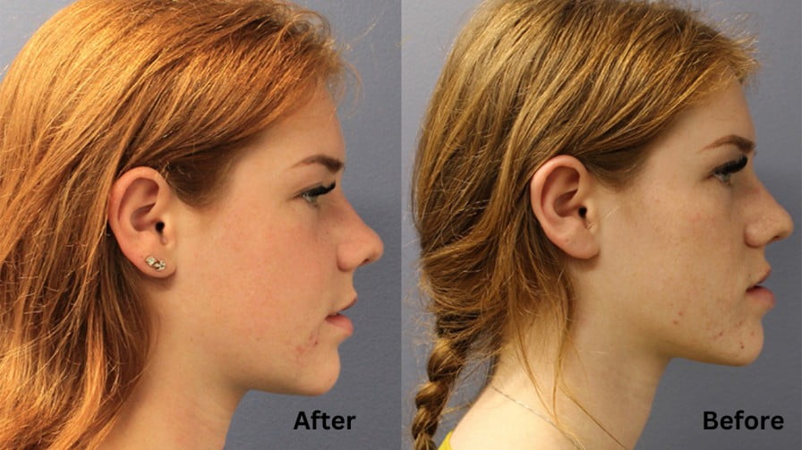 Jaw Surgery Before and After